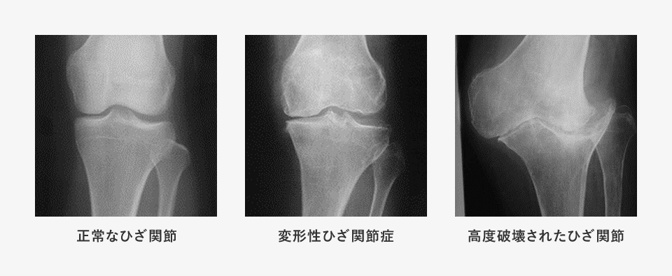 変形性ひざ関節症とは