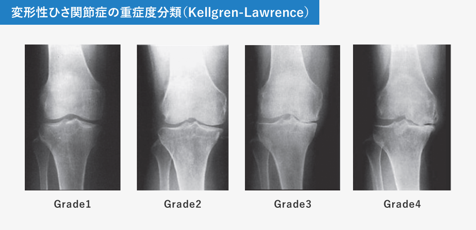 変形性ひさ関節症の重症度分類（Kellgren-Lawrence）