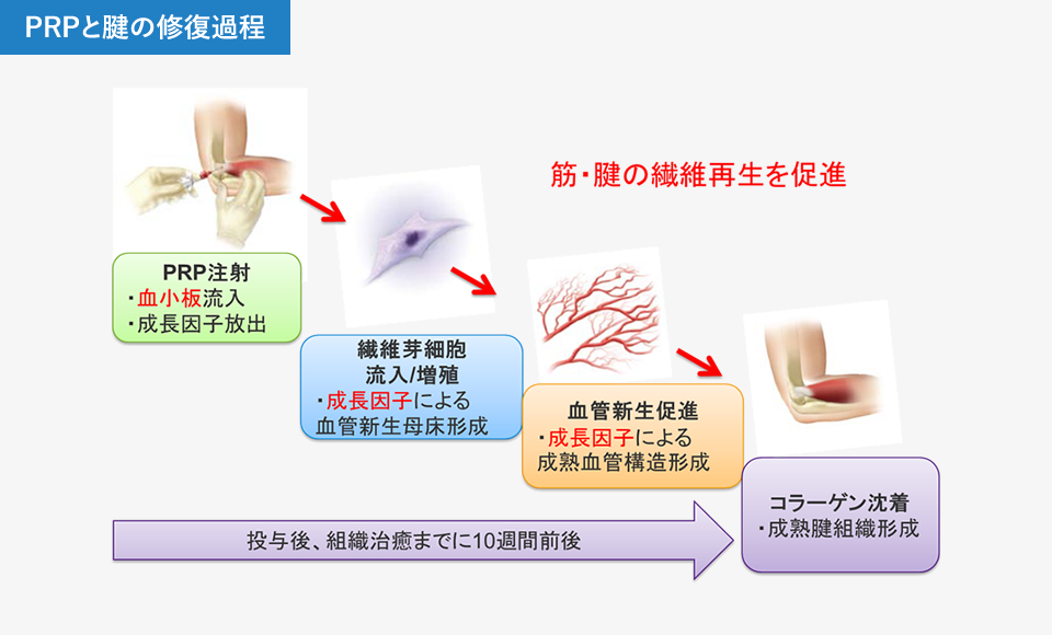 PRPと腱の修復過程